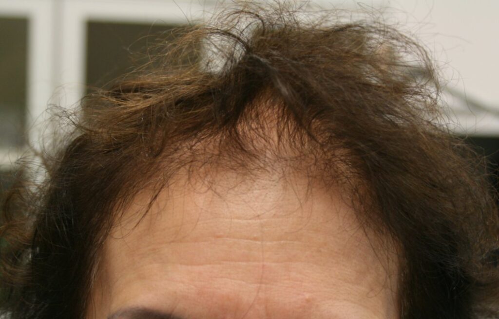HAIRestart™ with PRP — before