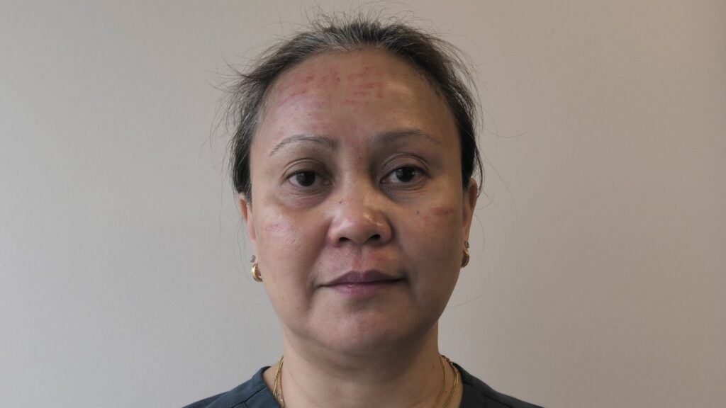 U-Plasma · Microneedling + PRP — before