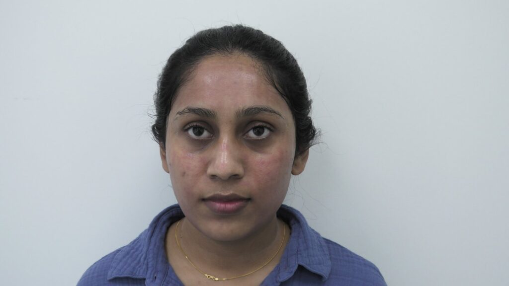 U-Plasma · Microneedling + PRP — before